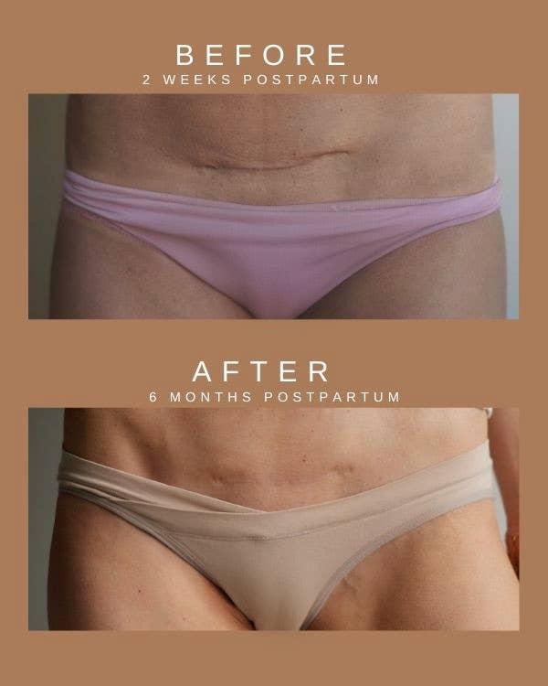 Restorative C-Section Scar Cream